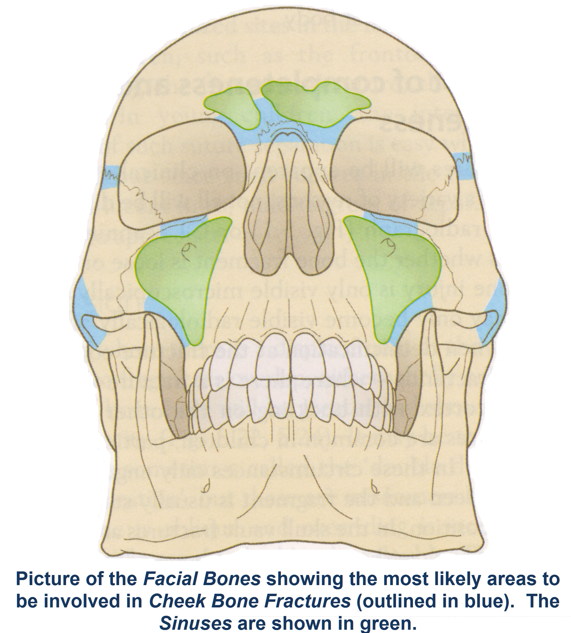 Fractures of the Cheek Bone3